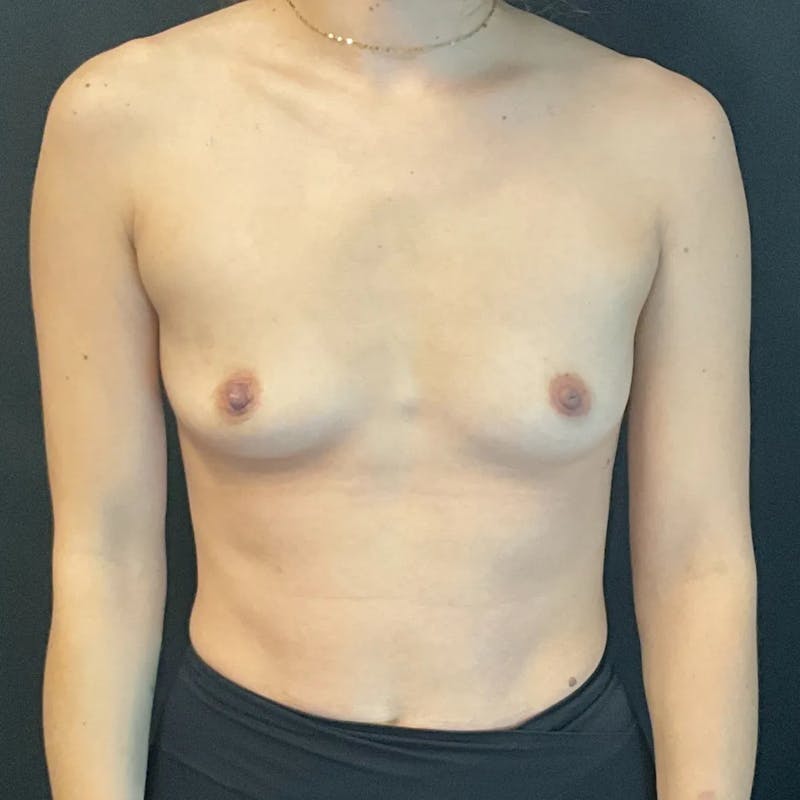 Breast Augmentation Before & After Gallery - Patient 111144 - Image 1