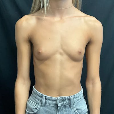Breast Augmentation Before & After Gallery - Patient 263740 - Image 1