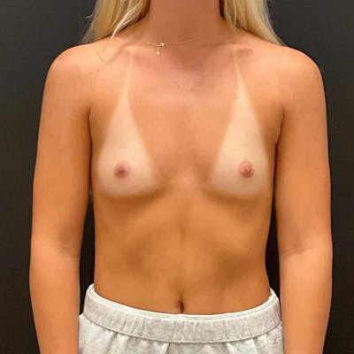 Breast Augmentation Before & After Gallery - Patient 388965 - Image 1