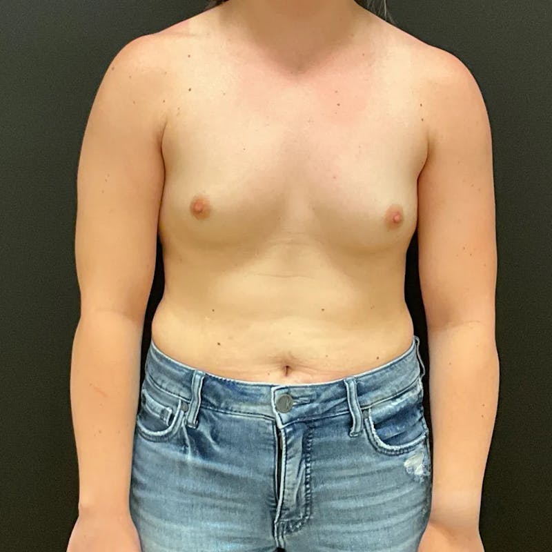 Breast Augmentation Before & After Gallery - Patient 687879 - Image 1