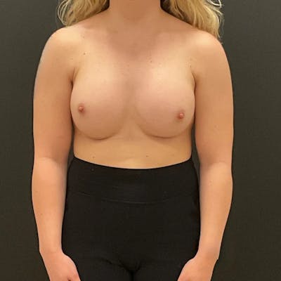 Breast Augmentation Before & After Gallery - Patient 687879 - Image 2