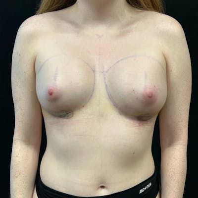 Breast Augmentation Before & After Gallery - Patient 330256 - Image 2
