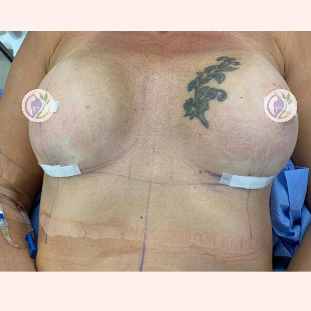 Corrective Surgery