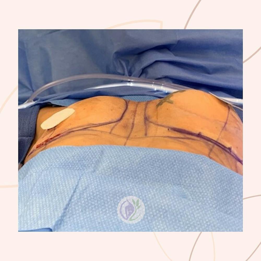 Corrective Surgery - During Procedure
