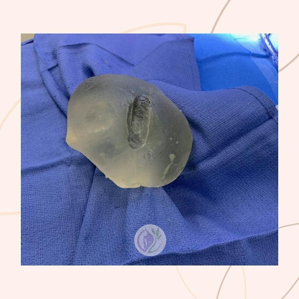 Breast Implant