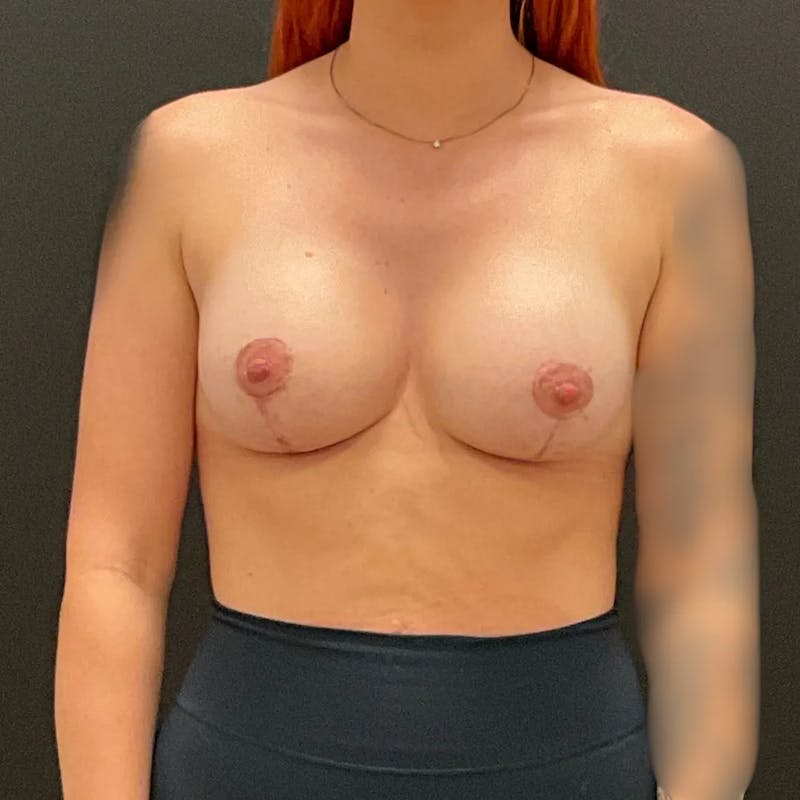 Breast Augmentation & Lift Before & After Gallery - Patient 196533 - Image 2