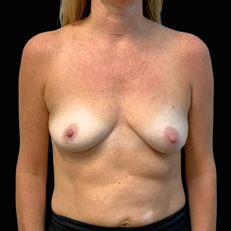 Breast Augmentation & Lift Before & After Gallery - Patient 128811 - Image 1