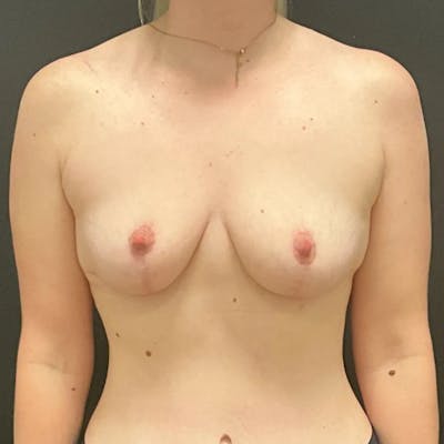 Breast Lift Before & After Gallery - Patient 597425 - Image 2