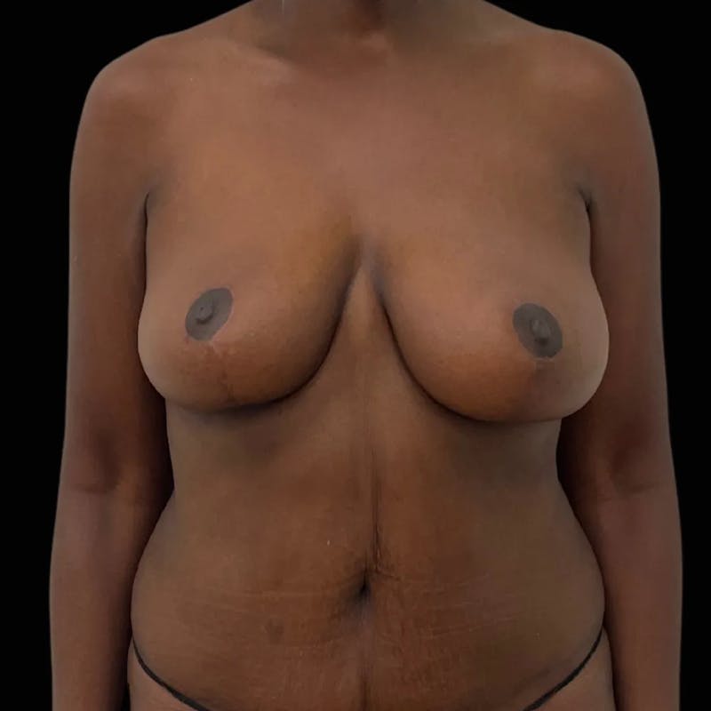 Breast Lift Before & After Gallery - Patient 954018 - Image 2