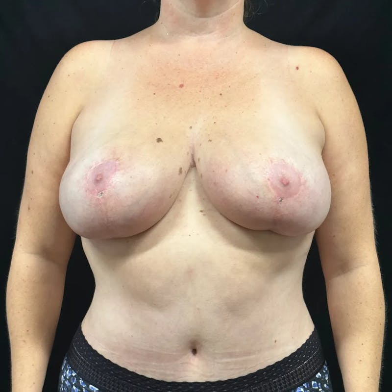 Breast Reduction Before & After Gallery - Patient 274570 - Image 2