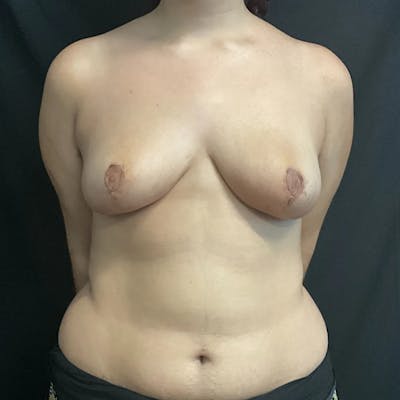 Breast Reduction Before & After Gallery - Patient 215528 - Image 2
