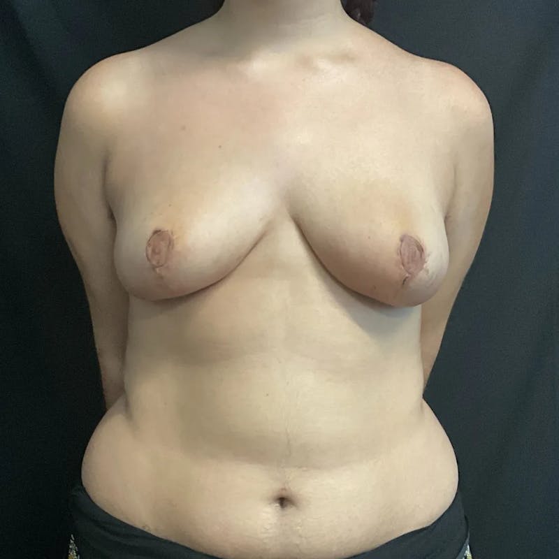 Breast Reduction Before & After Gallery - Patient 215528 - Image 2