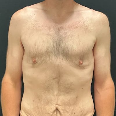 Gynecomastia Before & After Gallery - Patient 400024 - Image 1