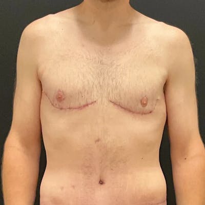 Gynecomastia Before & After Gallery - Patient 400024 - Image 2