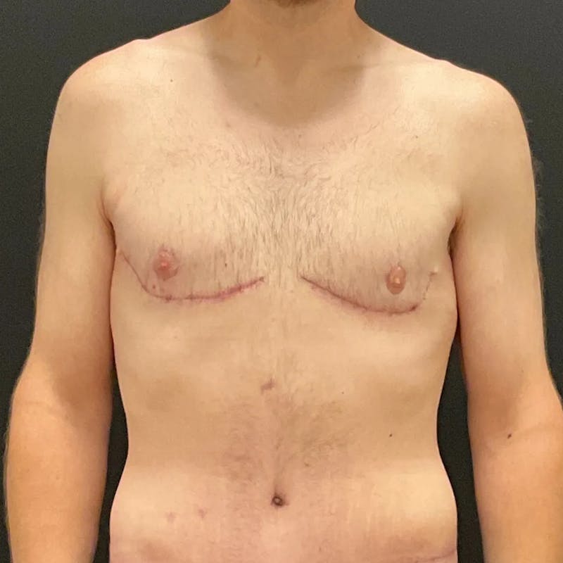 Gynecomastia Before & After Gallery - Patient 400024 - Image 2