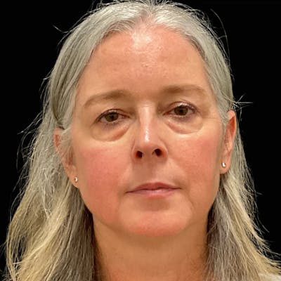 Upper & Lower Blepharoplasty Before & After Gallery - Patient 293070 - Image 1