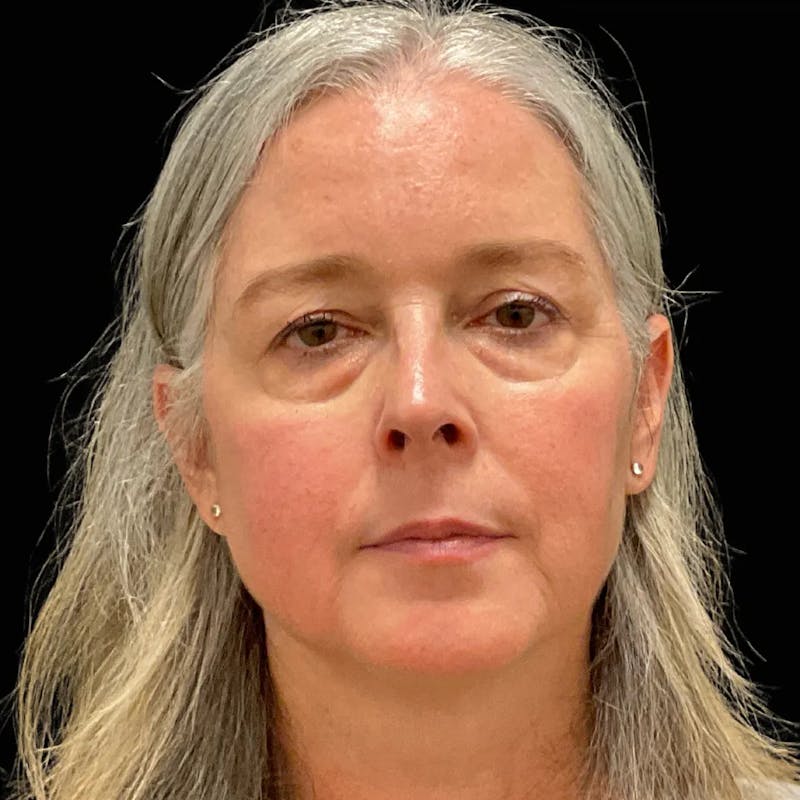 Upper & Lower Blepharoplasty Before & After Gallery - Patient 293070 - Image 1