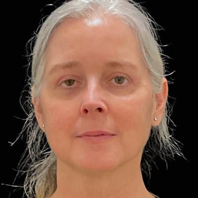 Upper & Lower Blepharoplasty Before & After Gallery - Patient 293070 - Image 2