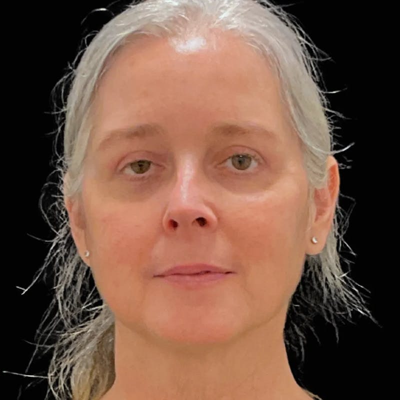 Upper & Lower Blepharoplasty Before & After Gallery - Patient 293070 - Image 2