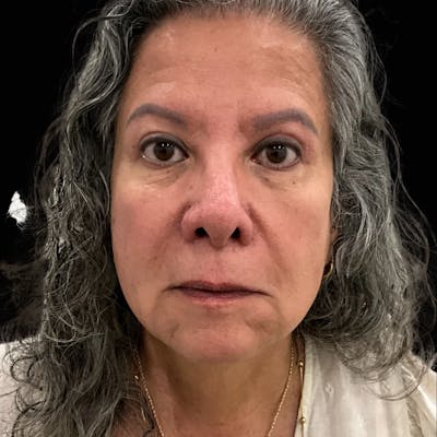 Upper Blepharoplasty Before & After Gallery - Patient 137343 - Image 2