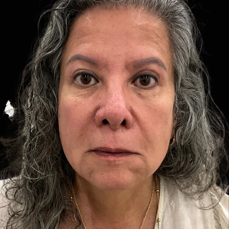 Upper Blepharoplasty Before & After Gallery - Patient 137343 - Image 2