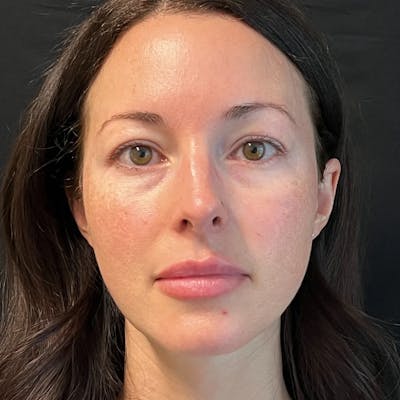 Upper Blepharoplasty Before & After Gallery - Patient 175142 - Image 1