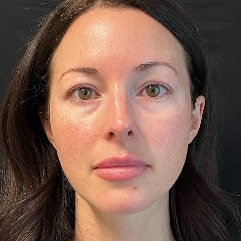 Upper Blepharoplasty Before & After Gallery - Patient 175142 - Image 1