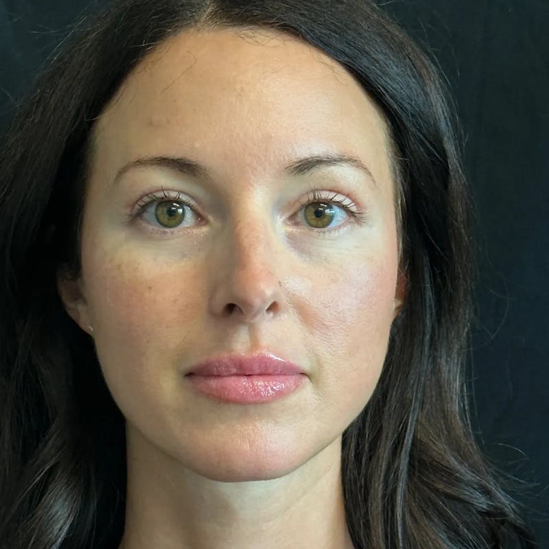 Upper Blepharoplasty Before & After Gallery - Patient 175142 - Image 2