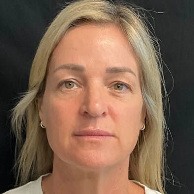 Upper Blepharoplasty Before & After Gallery - Patient 413384 - Image 1