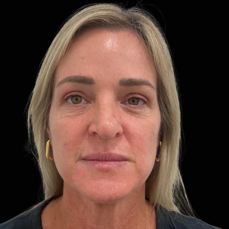 Upper Blepharoplasty Before & After Gallery - Patient 413384 - Image 2