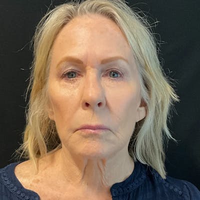 Upper Blepharoplasty Before & After Gallery - Patient 359074 - Image 1