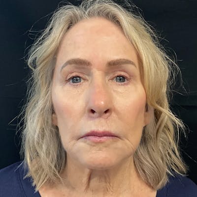 Upper Blepharoplasty Before & After Gallery - Patient 359074 - Image 2