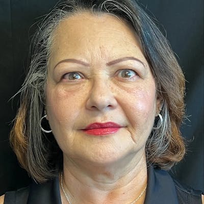Upper Blepharoplasty Before & After Gallery - Patient 961419 - Image 1