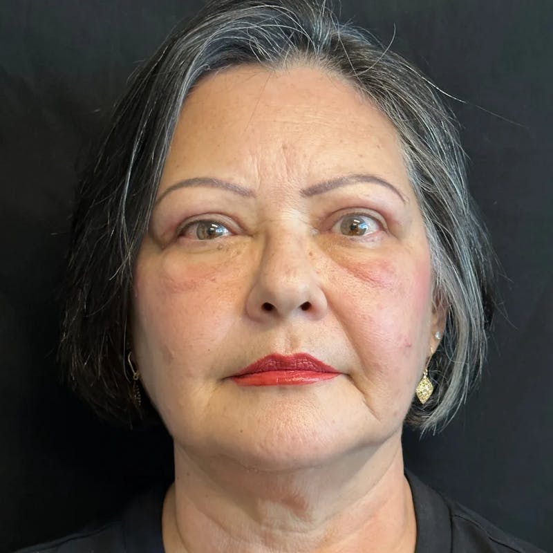 Upper Blepharoplasty Before & After Gallery - Patient 961419 - Image 2