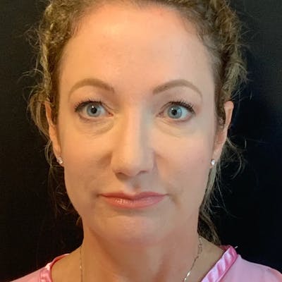 Upper Blepharoplasty Before & After Gallery - Patient 119262 - Image 1