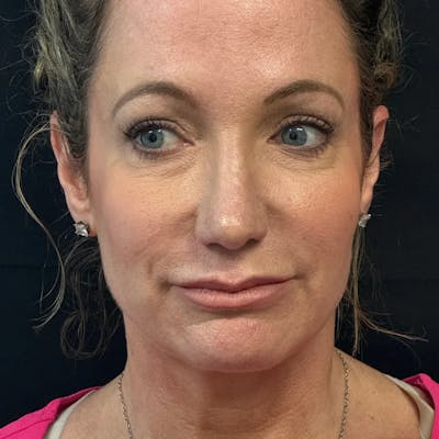 Upper Blepharoplasty Before & After Gallery - Patient 119262 - Image 2