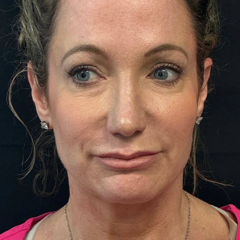 Upper Blepharoplasty Before & After Gallery - Patient 119262 - Image 2