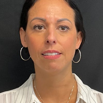 Upper Blepharoplasty Before & After Gallery - Patient 866296 - Image 1