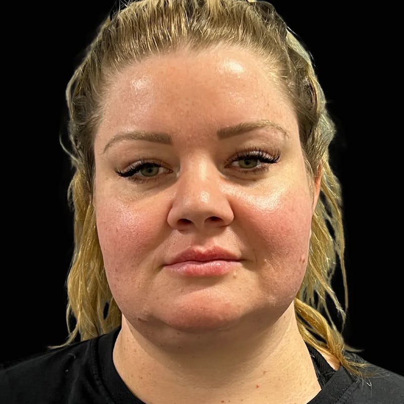 Zoom Neck Lift Before & After Gallery - Patient 137220 - Image 1