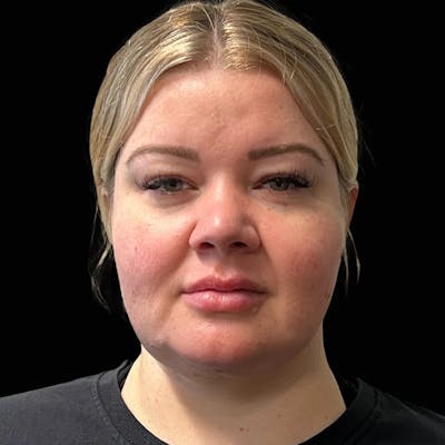 Zoom Neck Lift Before & After Gallery - Patient 137220 - Image 2