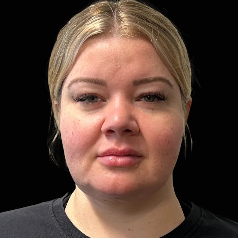 Zoom Neck Lift Before & After Gallery - Patient 137220 - Image 2