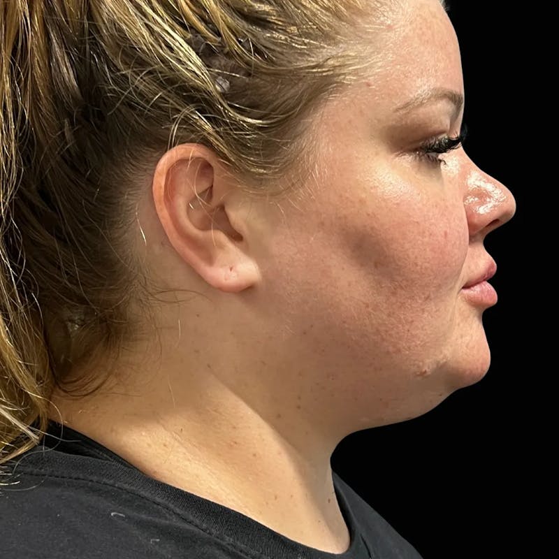 Zoom Neck Lift Before & After Gallery - Patient 137220 - Image 3
