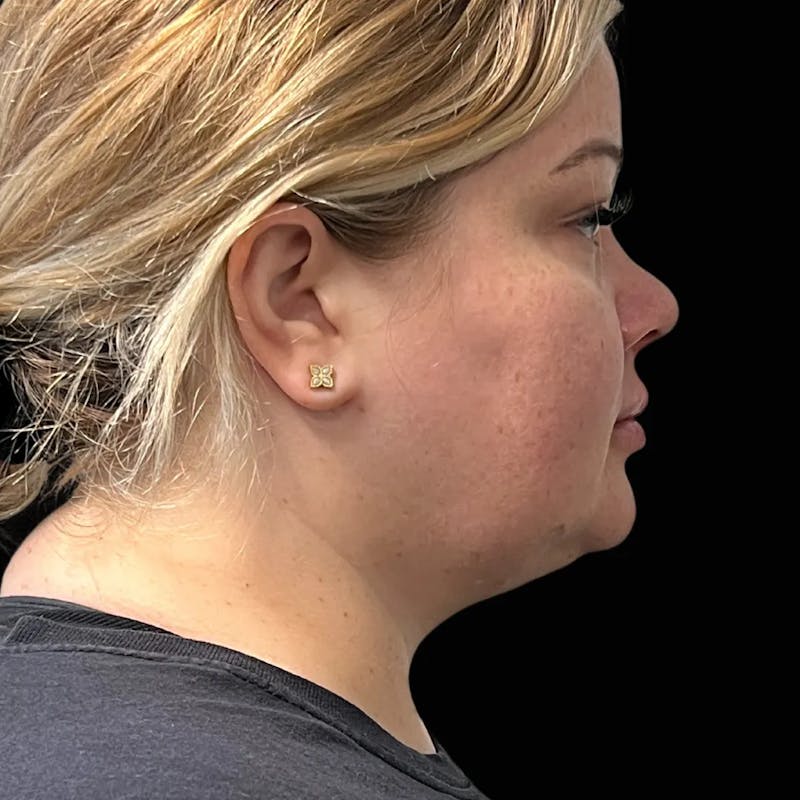 Zoom Neck Lift Before & After Gallery - Patient 137220 - Image 4