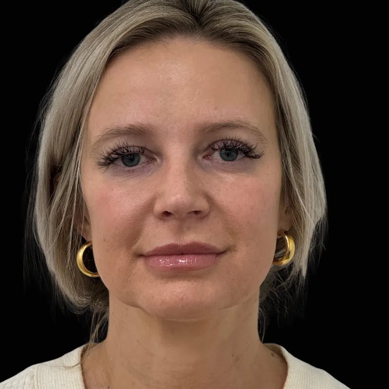 Zoom Neck Lift Before & After Gallery - Patient 260117 - Image 1