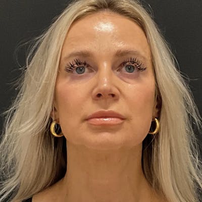 Zoom Neck Lift Before & After Gallery - Patient 260117 - Image 2