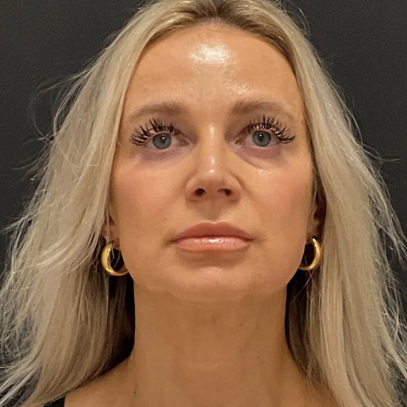 Zoom Neck Lift Before & After Gallery - Patient 260117 - Image 2