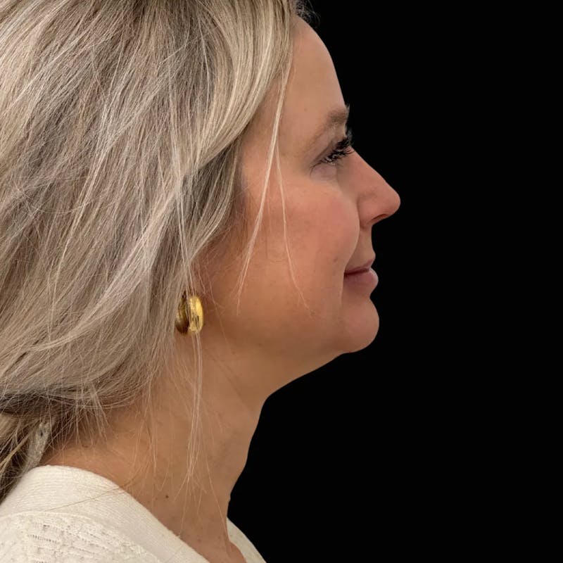 Zoom Neck Lift Before & After Gallery - Patient 260117 - Image 3