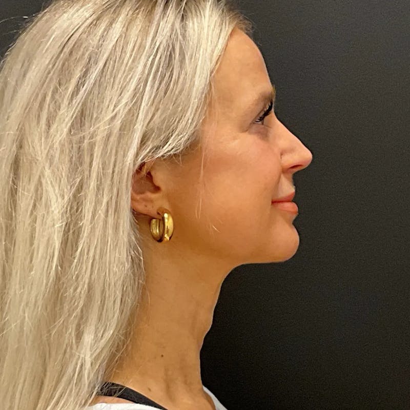 Zoom Neck Lift Before & After Gallery - Patient 260117 - Image 4