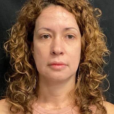 Zoom Neck Lift Before & After Gallery - Patient 314720 - Image 1