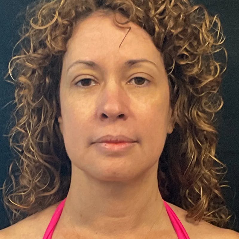 Zoom Neck Lift Before & After Gallery - Patient 314720 - Image 2